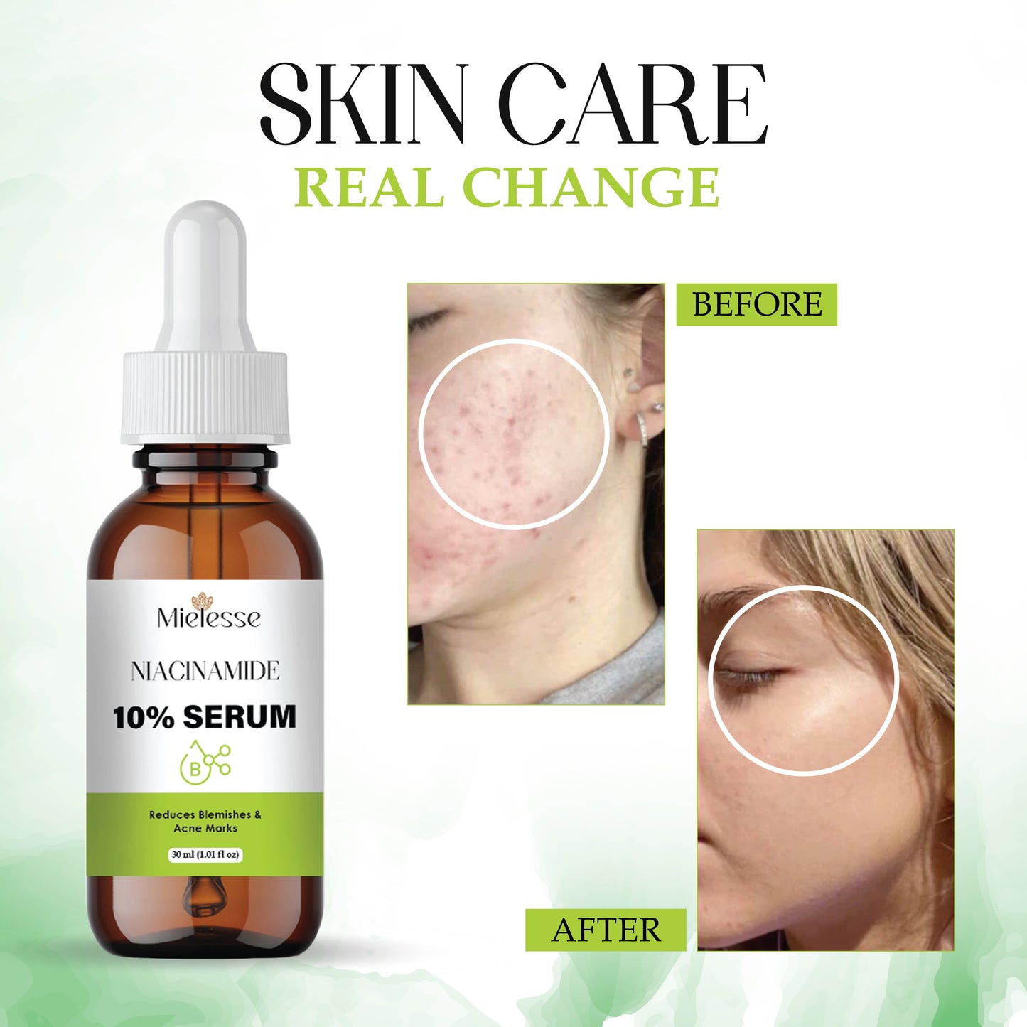 Niacinamide Serum 10% for Face | Reduces Acne Marks, Dark Spots & Oiliness | Brightening & Hydrating Face Serum for Clear, Even-Toned Skin | Lightweight, Non-Sticky Formula