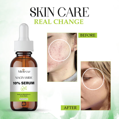 Niacinamide Serum 10% for Face | Reduces Acne Marks, Dark Spots & Oiliness | Brightening & Hydrating Face Serum for Clear, Even-Toned Skin | Lightweight, Non-Sticky Formula
