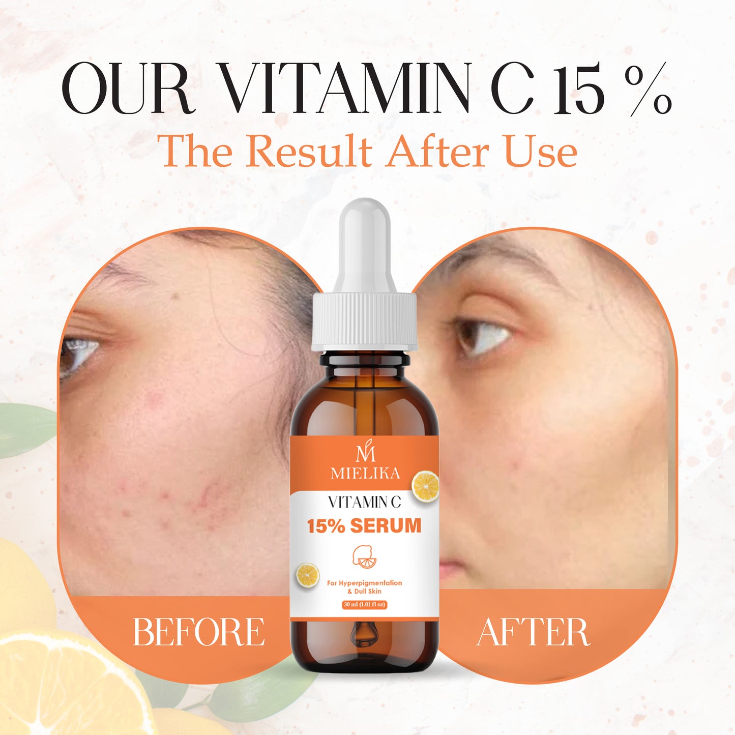 Vitamin C Face Serum for Glowing Skin | Brightening & Anti-Aging Serum with Hyaluronic Acid & Vitamin E | Fades Dark Spots, Evens Skin Tone, Reduces Fine Lines | For Men & Women – 30ml